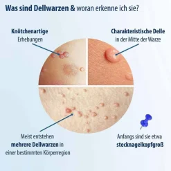 Evolsin Dellwarzen Mittel Lösung, 5 ml> Warzenstift