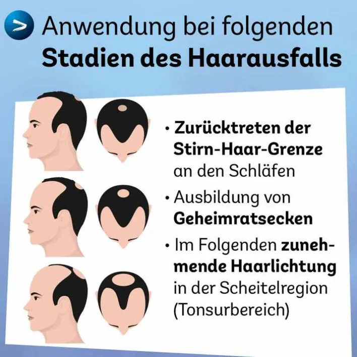 Dexcel Minoxidil 50 mg / ml Spray z.Anw.a.d.Kopfhaut, 60 ml> Mittel Gegen Haarausfall