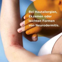 Soventol® HydroCort 0,5% Creme bei akuten Hautentzündungen, 15 g